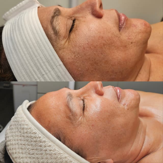 SWiCH Facial at Nora's Pampering Esthetics in Escondido, CA